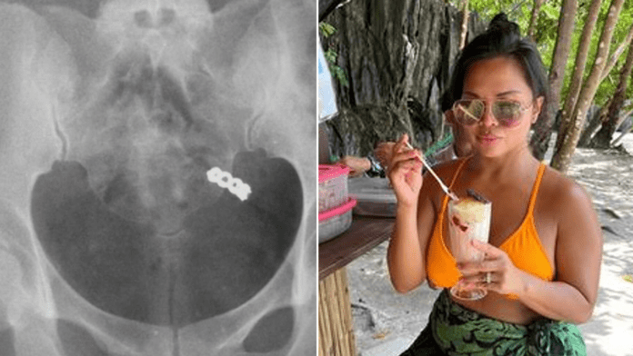 Woman accidentally swallows wedding ring while taking vitamins