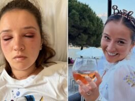 Bride gets severe allergic reaction to eyelash extensions before wedding Bride gets severe allergic reaction to eyelash extensions before wedding