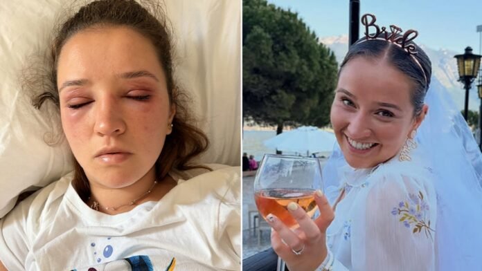 Bride gets severe allergic reaction to eyelash extensions before wedding