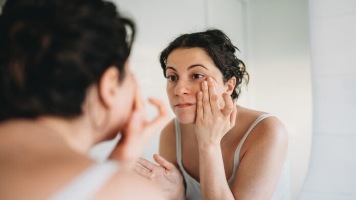 'Ferritin face' trend links dark under-eye circles to low iron stores as doctors weigh in